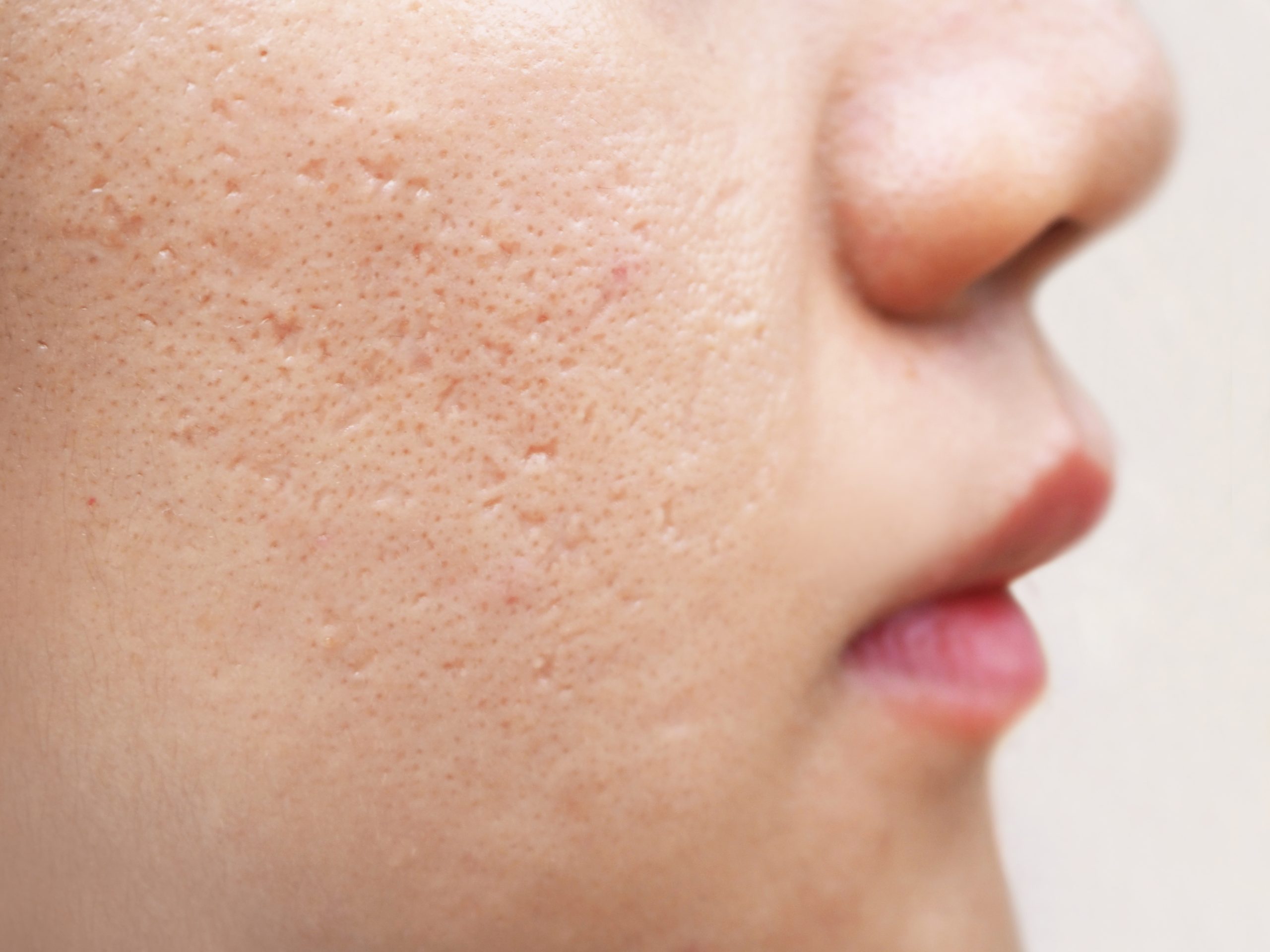 Acne Scarring​